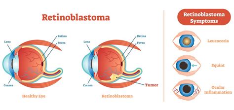 Signs And Symptoms Eye Cancer And Tumors Types Of Eye Cancers