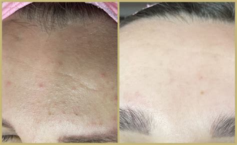 Biorepeel Bedford Nue Skin And Laser Clinic