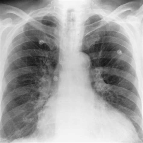 Pdf Aortic Calcification On Plain Chest Radiography Increases Risk