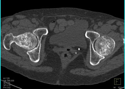 Bilateral Avascular Necrosis Of The Femoral Heads Musculoskeletal