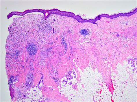 Pathology Outlines Desmoplastic Melanoma