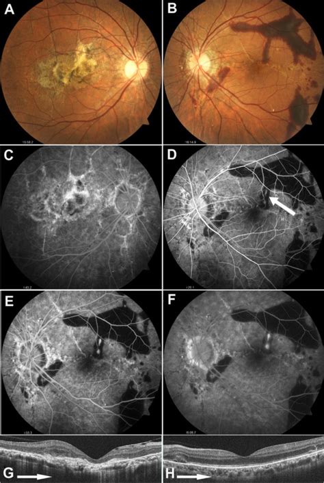 Fundus Findings On Initial Examination Notes A And B Fundus