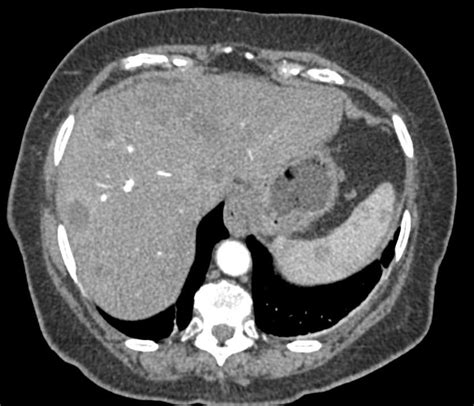 Choledochal Cyst Common Bile Duct With Ercp Gastrointestinal Case