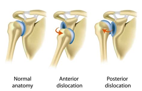 Dislocated Shoulder Instability Orthopedic Shoulder Specialist
