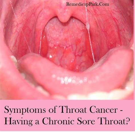 Collection 95 Pictures Photos Of Early Throat Cancer Superb