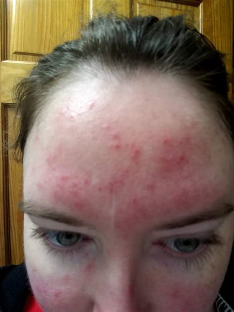 26 Photos That Show How Autoimmune Disease Affects The Skin The Mighty