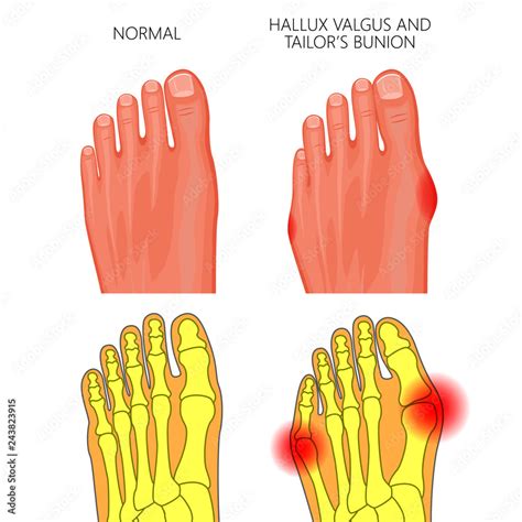 Illustration Of The Normal Foot Valgus Deviation Of The First Toe And