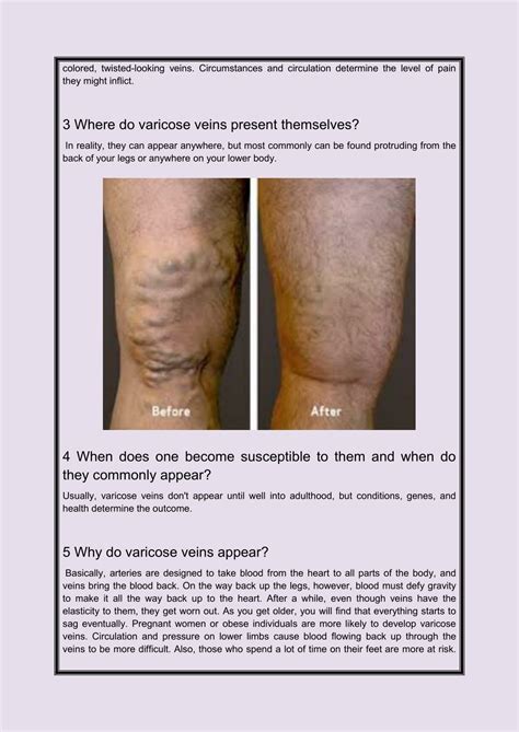 Ppt What Are The 5 “ws” Of Varicose Veins Powerpoint Presentation