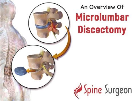 An Overview Of Microlumbar Discectomy Spine Surgeon