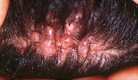 Tufted Folliculitis Of The Scalp And Treatment With Cyclosporine Hair