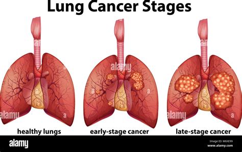 Lung Cancer Drawing Stock Photos And Lung Cancer Drawing Stock Images Alamy
