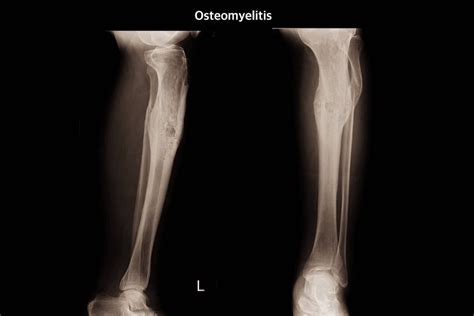 Bone Infection Osteomyelitis Sergio Mazzei