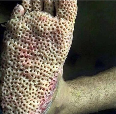 A Rather Holey Foot Trypophobia