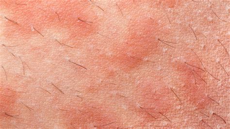 Atopic Dermatitis Types Of Eczema Gladskin