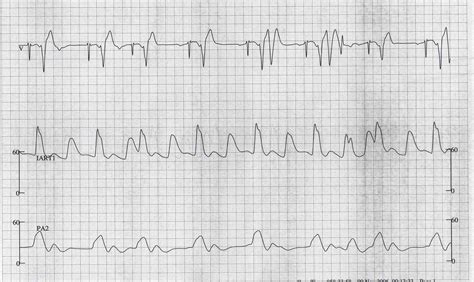 Premature Ventricular Contraction Ekg Examples Wikidoc