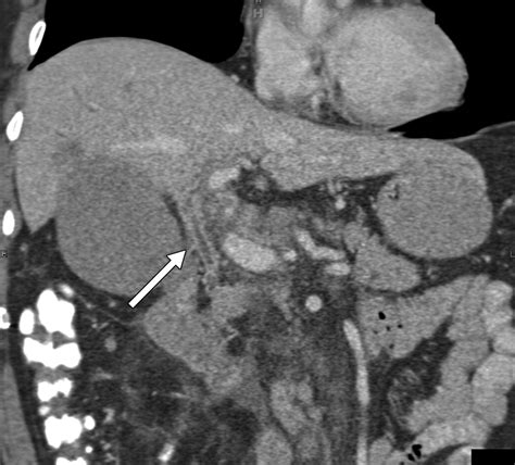 Abnormalities Of The Distal Common Bile Duct And Ampulla Diagnostic