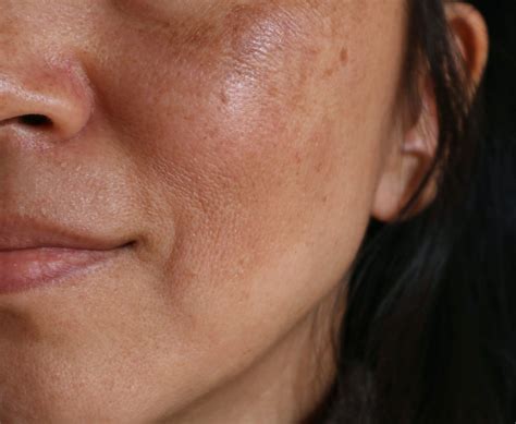 The Ultimate Guide To Dark Spots And Hyperpigmentation The Aedition