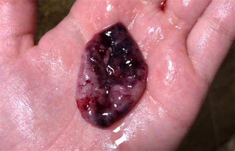 Do you have blood clots during periods for more than 24 hours? Little "sac" with black dot - no bfp - miscarriage? Long post and TMI - BabyCenter