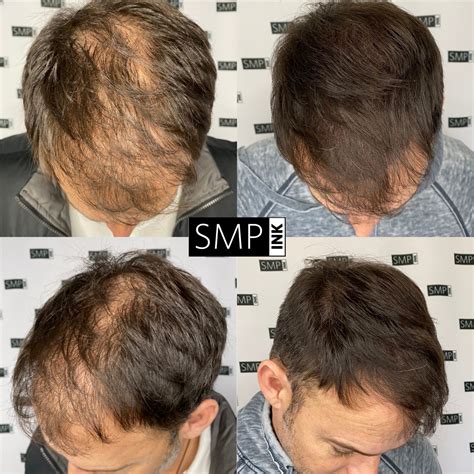 Pre And Post Scalp Micropigmentation Care Tips Smp Ink