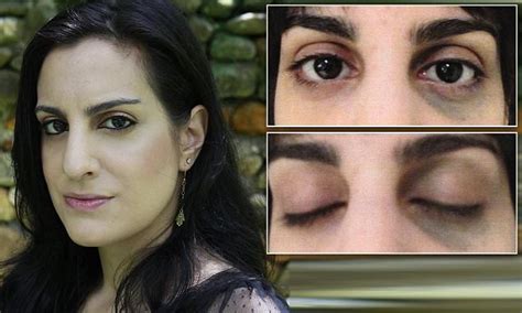 woman had surgery to remove a dark birth mark on her face daily mail online