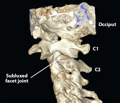 3d Ct Scan Of Upper Cervical Spine C1 C2 Instability Can