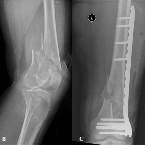Distal Femoral Replacement Versus ORIF For Severely Comminuted Distal Femur Fractures Request PDF