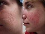 Laser Treatment For Acne Scars On Black Skin Images