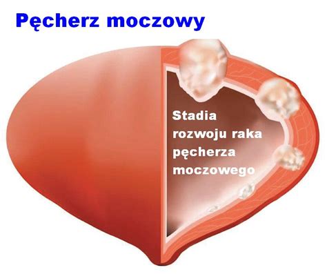 Ziarnica Z O Liwa Objawy Rokowania Przerzuty Przyczyny Tvn Zdrowie