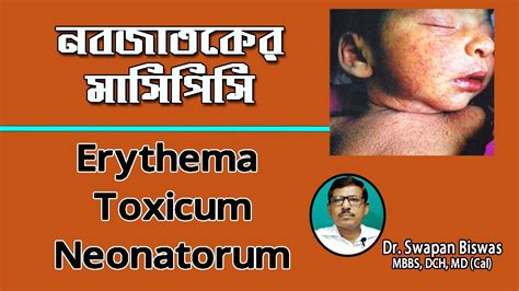 Erythema Toxicum Neonatorum নবজাতকের মাসিপিসি রোগ কতটা ভয়ঙ্কর Youtube