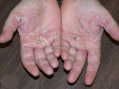 Eczema Hand Face Baby Causes Symptoms And Treatment