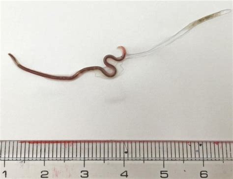 Doctors Remove Live Worm From Womans Tonsil