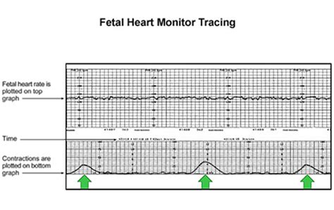 Aplikasi heart rate plus akan mengukur degupan jantung anda dengan. nurulnadiah: Kadar Degupan Jantung Bayi / Apakah CTG ...