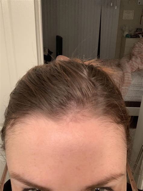 Hair thinning? It seems to just be in the front middle part of my ...