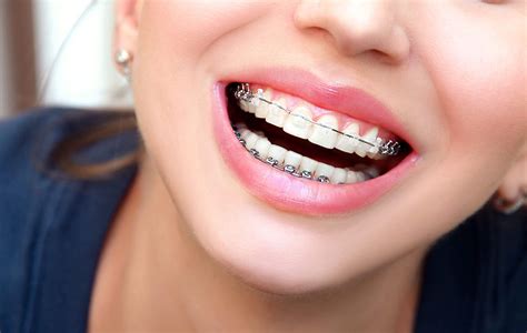 Mission Viejo Ceramic Braces South Oc Orthodontics