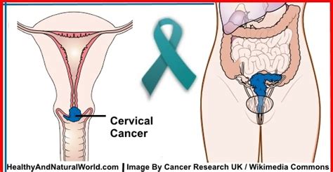 10 Warning Signs Of Cervical Cancer You Shouldnt Ignore