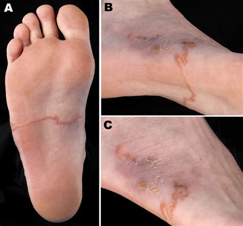 Practice Tip Cutaneous Larva Migrans This Changed My Practice