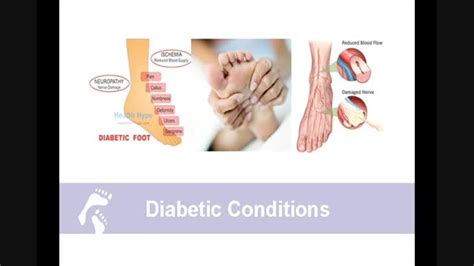 Diabetic Foot Care Podiatrist Long Island Nassau Podiatry