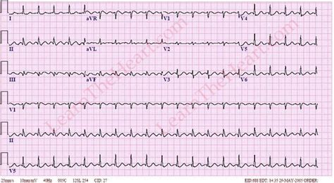 Atrial Flutter With 21 Conduction Ecg Example 1 Learn The Heart