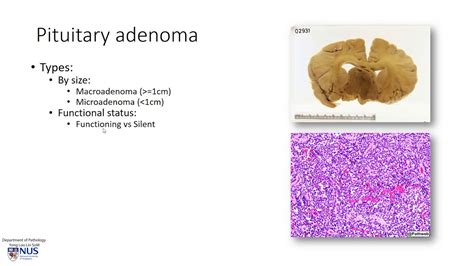 Brain Pituitary Adenoma Youtube