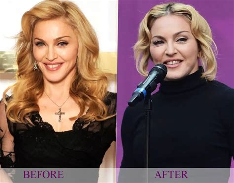 Celebs Before After Plastic Surgery