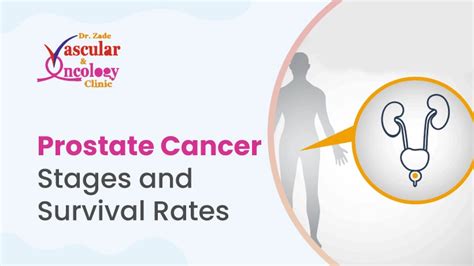 Prostate Cancer Survival Rate By Stage What You Need To Know