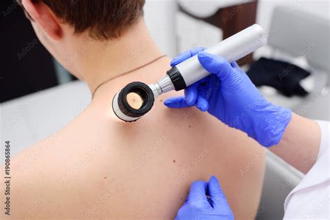 The Doctor Dermatologist Examines Birthmarks And Birthmarks Of The