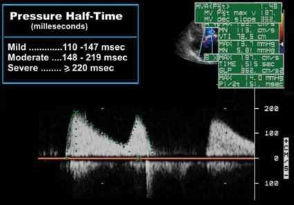 Mitral Valve Stenosis Area Lvot Echocardiography