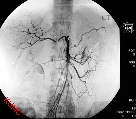 Celiac Arteriogram From Ku Radiographic Anatomy Radiology Radiology