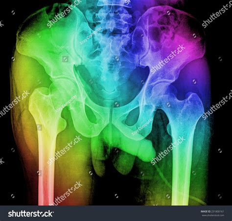 X Ray Image Pelvis And Hip Of A Man Stock Photo 231800161 Shutterstock