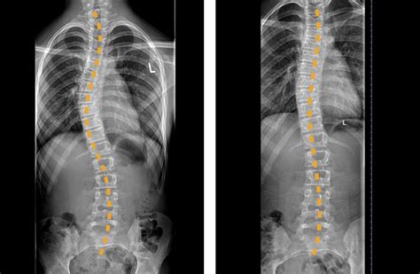 Scoliosis X Ray Before And After