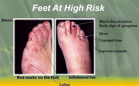 Diabetic Toes Pictures Symptoms And Pictures