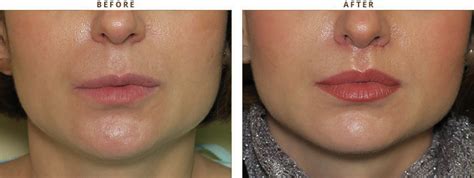 Lip Reshaping Before And After