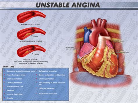 Angina Is Said To Be Unstable When The Attacks Occur More Frequently