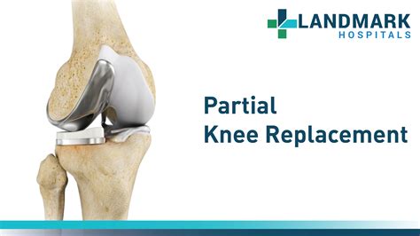 Partial Knee Replacement In Hyderabad By Dr Sudhir Kumar Reddy